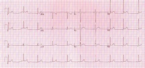 validity of ecg result|Athlete ECGs: How to Interpret and Know When and How to .